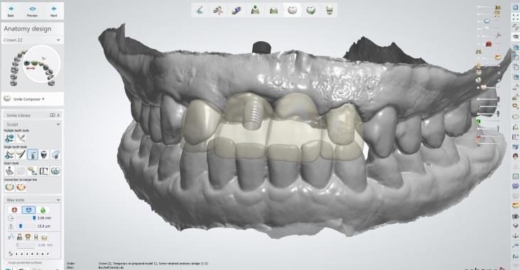 Full-arch restoration designed in 3Shape CAD